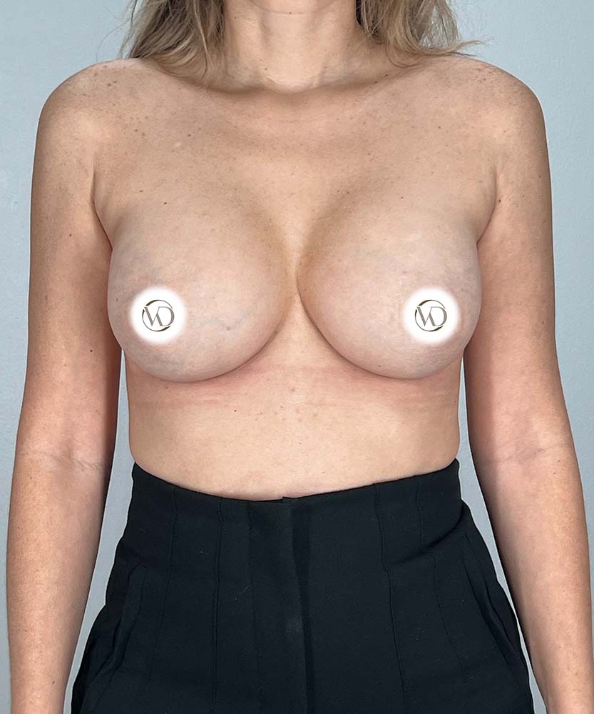 Breast Augmentation Before & After Image