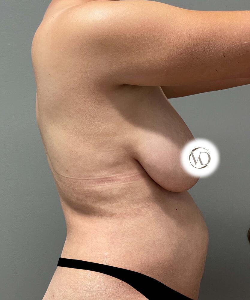 Breast Lift With Implants Before & After Image