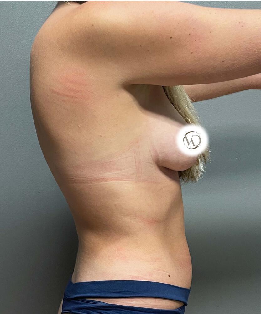 Breast Lift With Implants Before & After Image