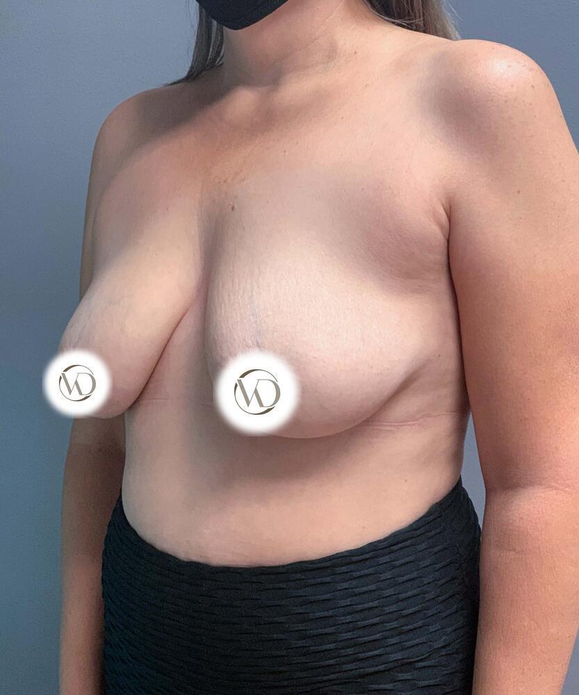 Breast Lift With Implants Before & After Image