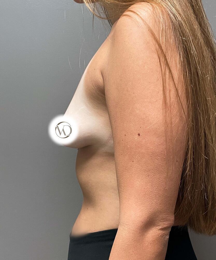 Breast Lift With Implants Before & After Image