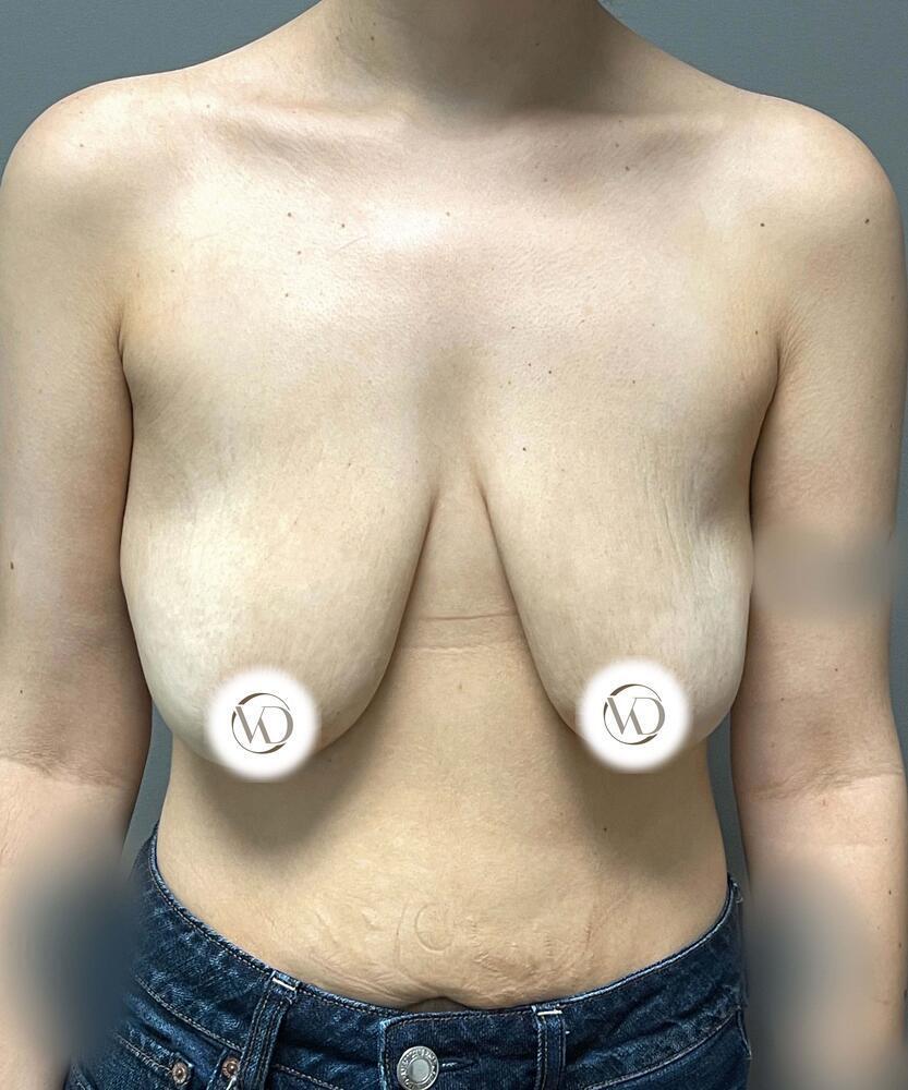 Breast Lift With Implants Before & After Image