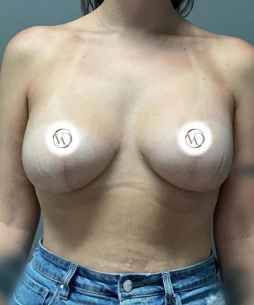 Breast Lift With Implants Before & After Image