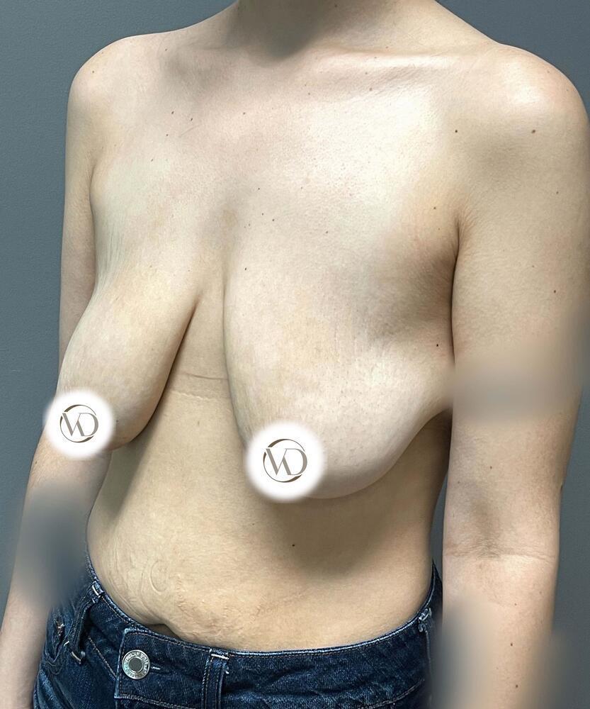 Breast Lift With Implants Before & After Image