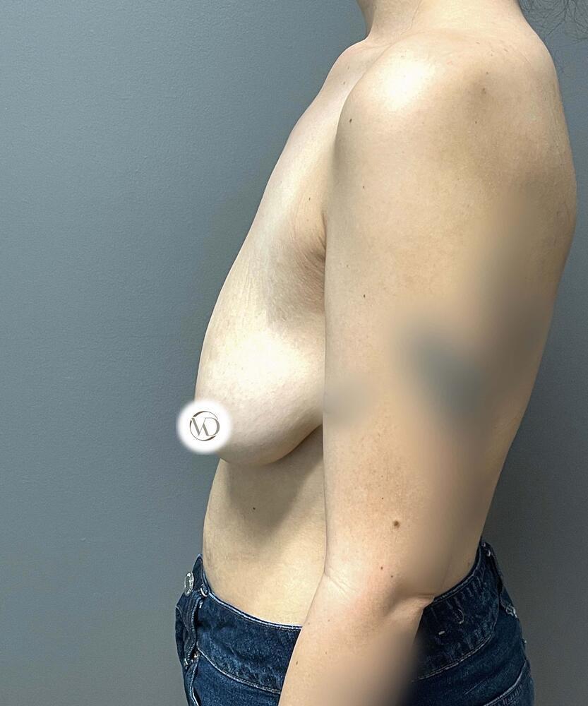 Breast Lift With Implants Before & After Image