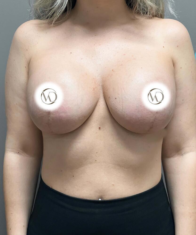 Breast Lift With Implants Before & After Image
