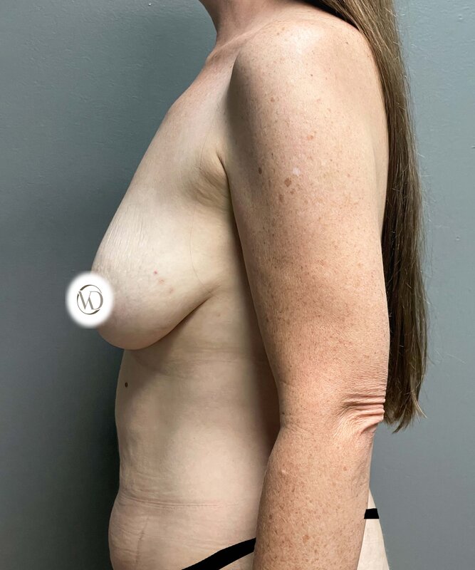 Breast Lift With Implants Before & After Image
