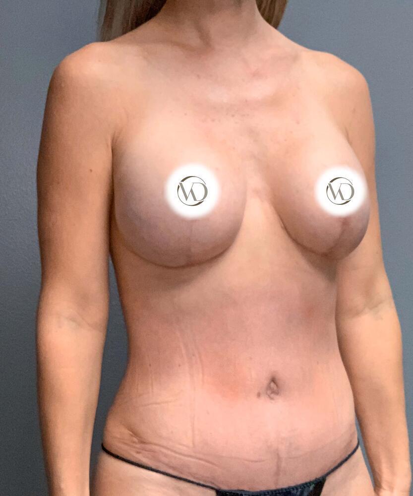 Breast Lift With Implant Exchange Before & After Image