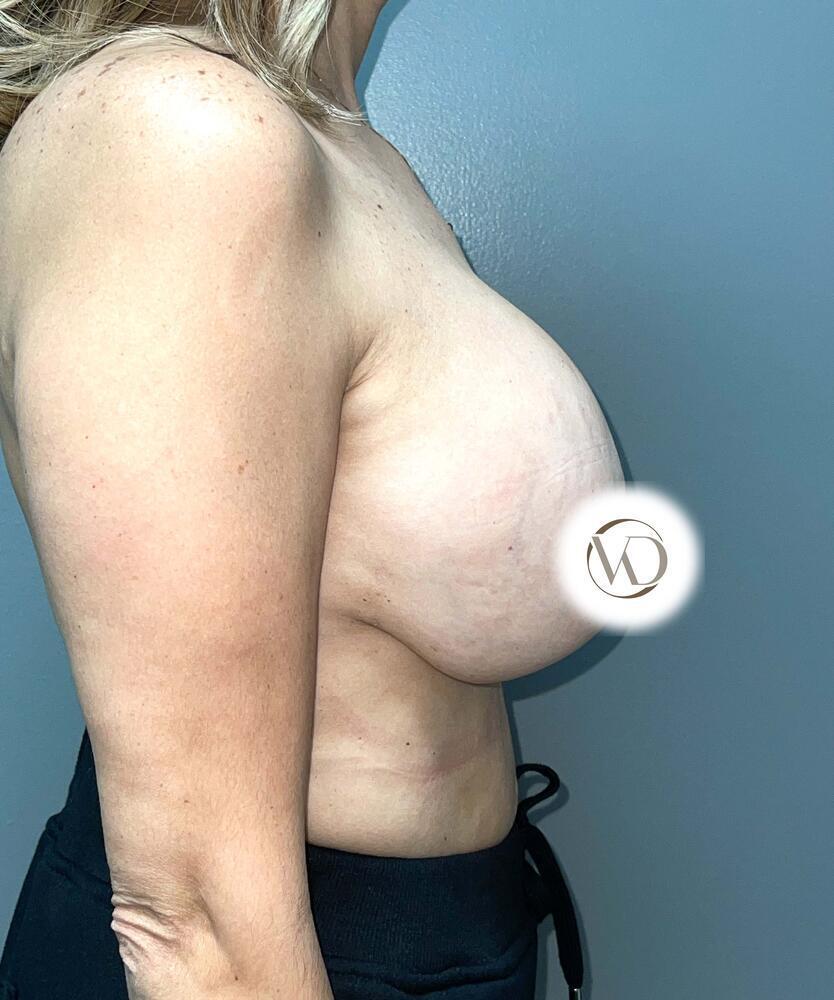 Breast Lift With Implant Exchange Before & After Image