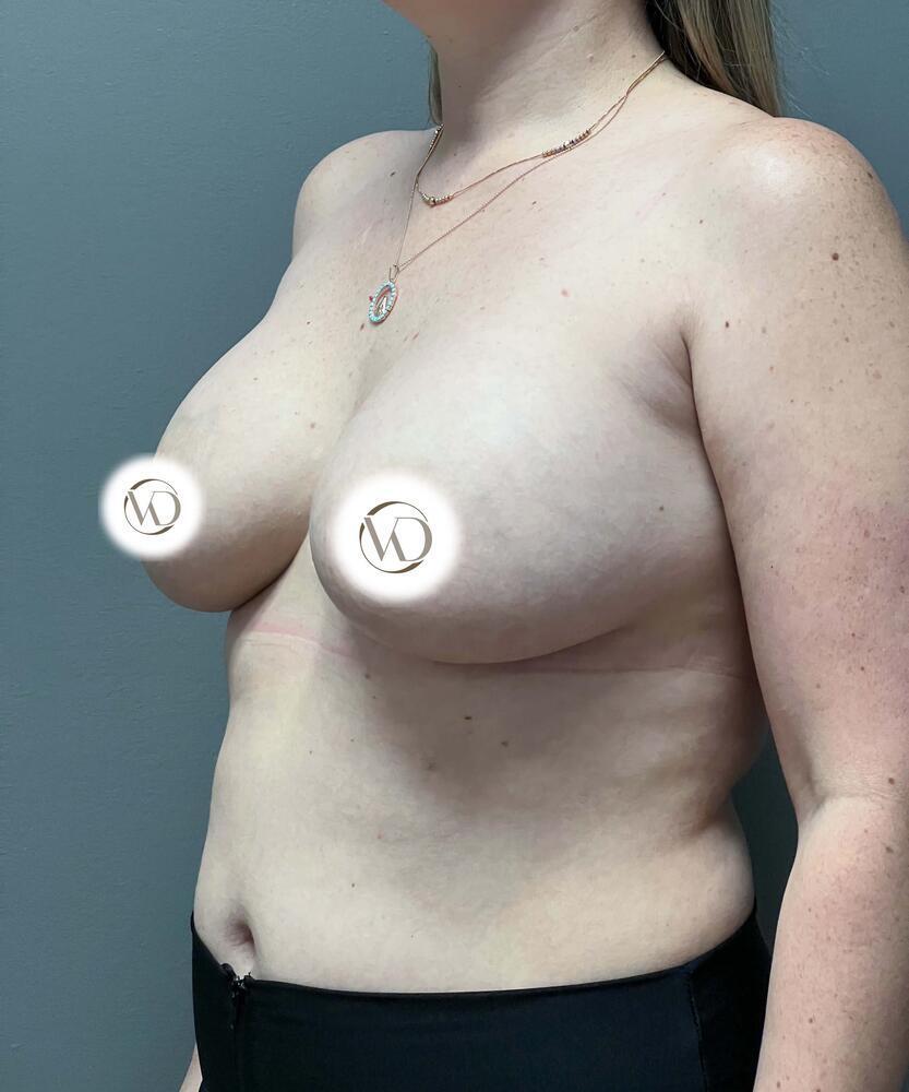 Breast Lift With Implant Exchange Before & After Image