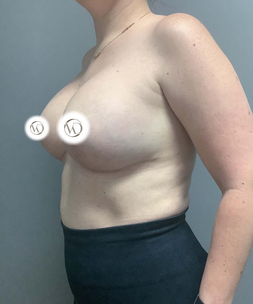 Breast Lift With Implant Exchange Before & After Image