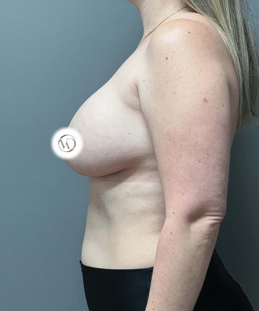 Breast Lift With Implant Exchange Before & After Image
