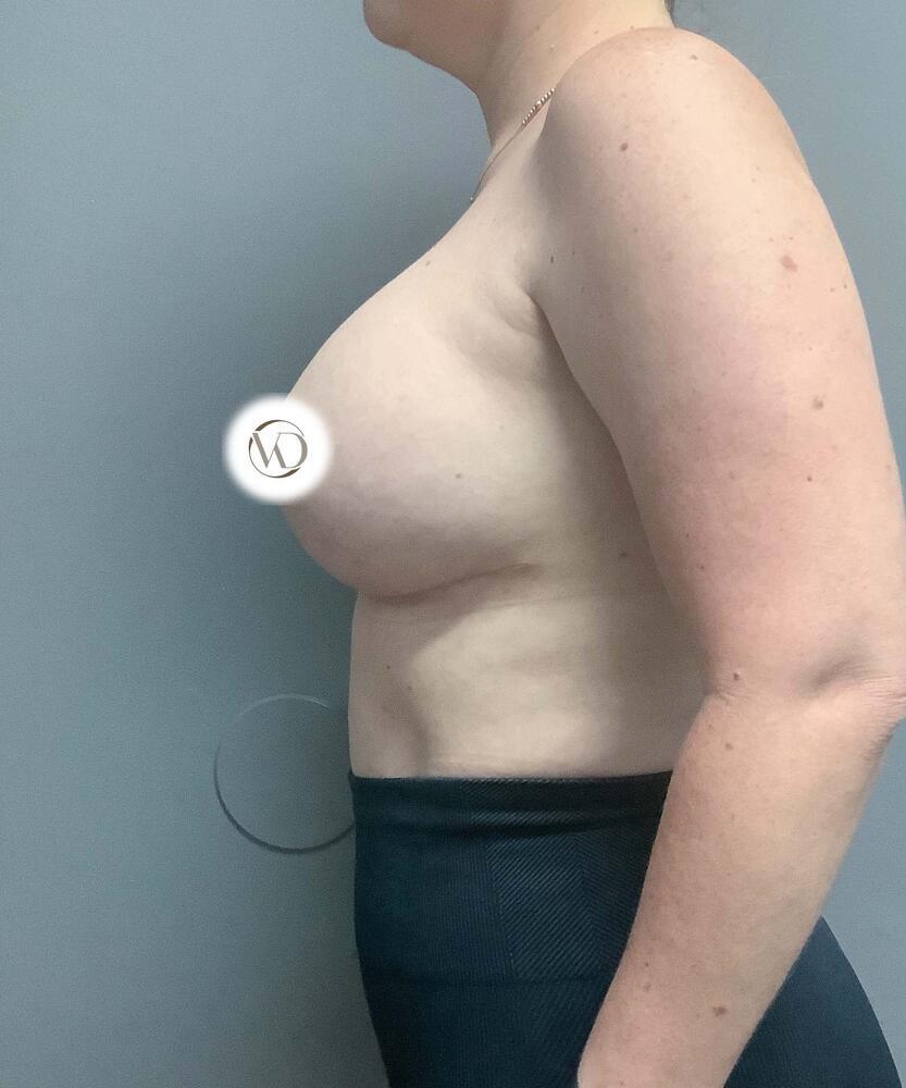 Breast Lift With Implant Exchange Before & After Image