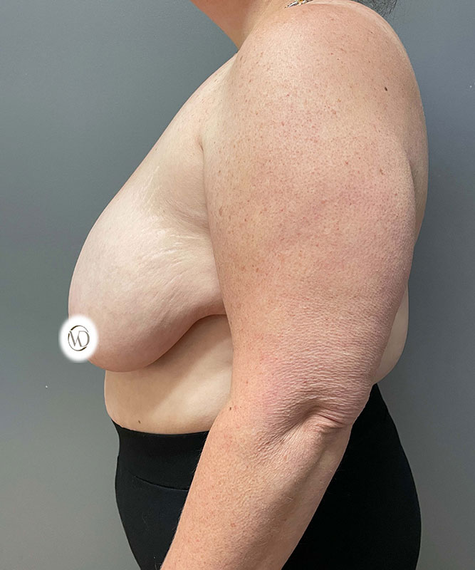 Breast Lift Before & After Image