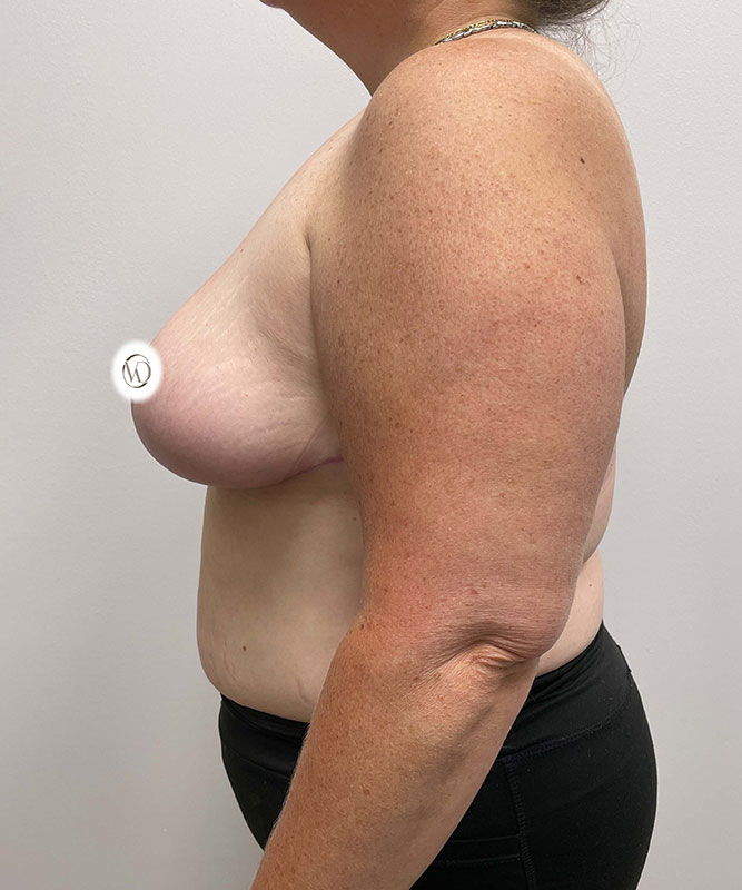 Breast Lift Before & After Image