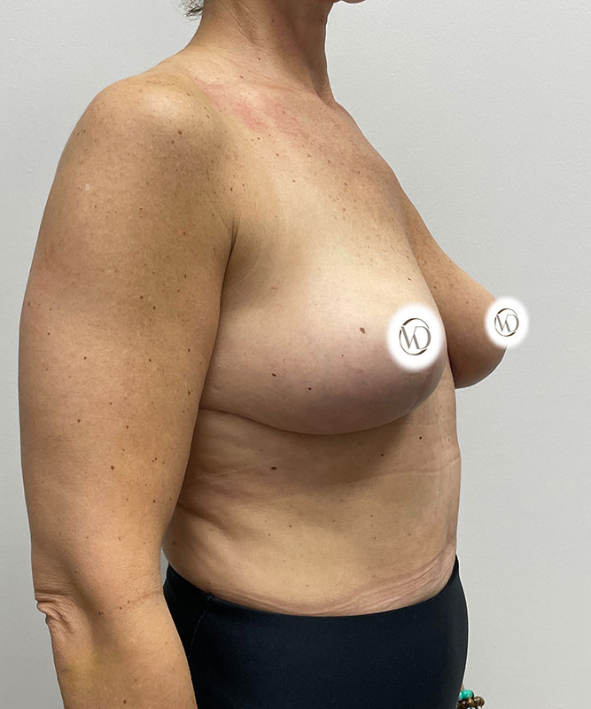 Breast Lift Before & After Image