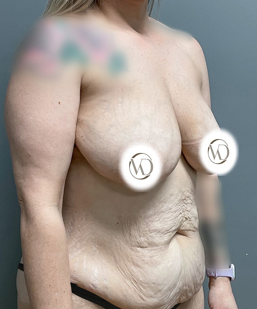 Breast Lift Before & After Image