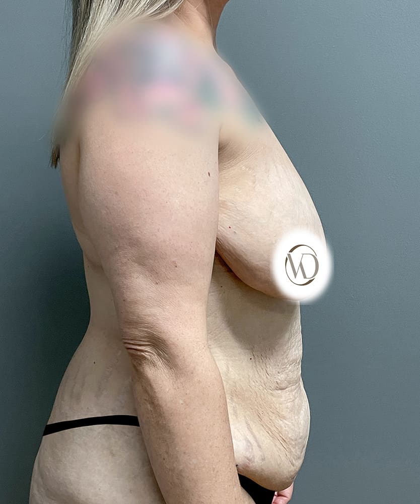 Breast Lift Before & After Image