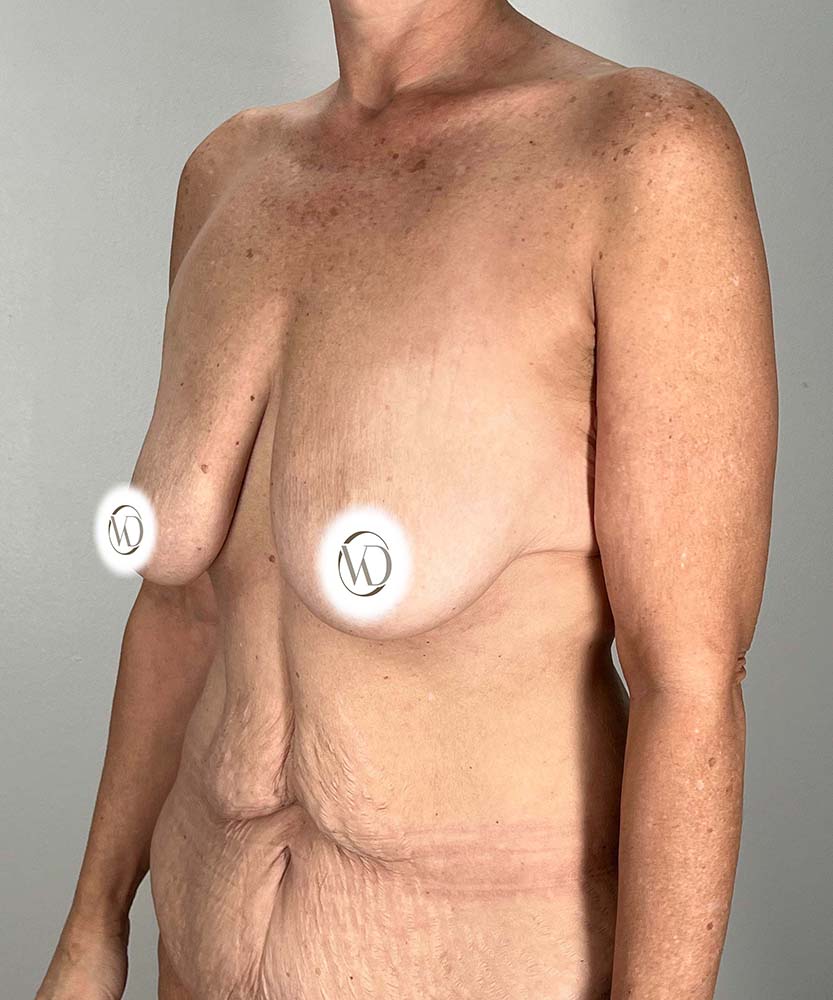 Breast Lift Before & After Image