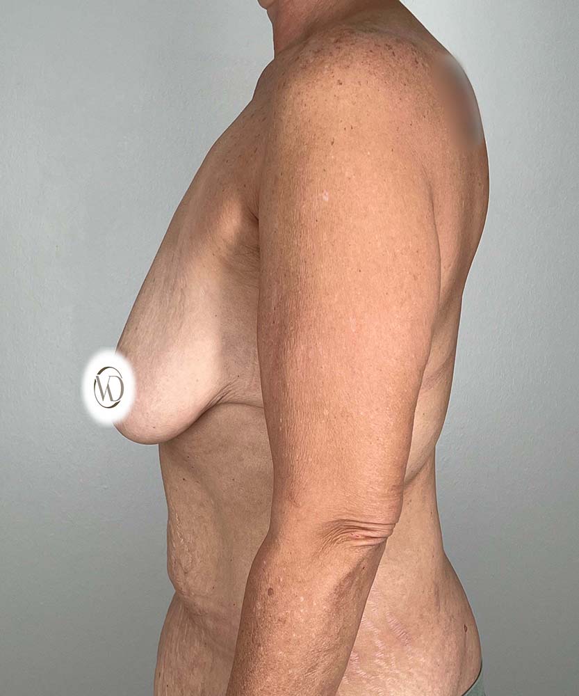 Breast Lift Before & After Image