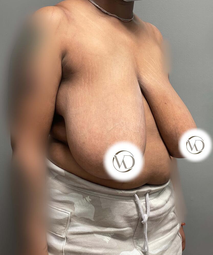Breast Reduction Before & After Image