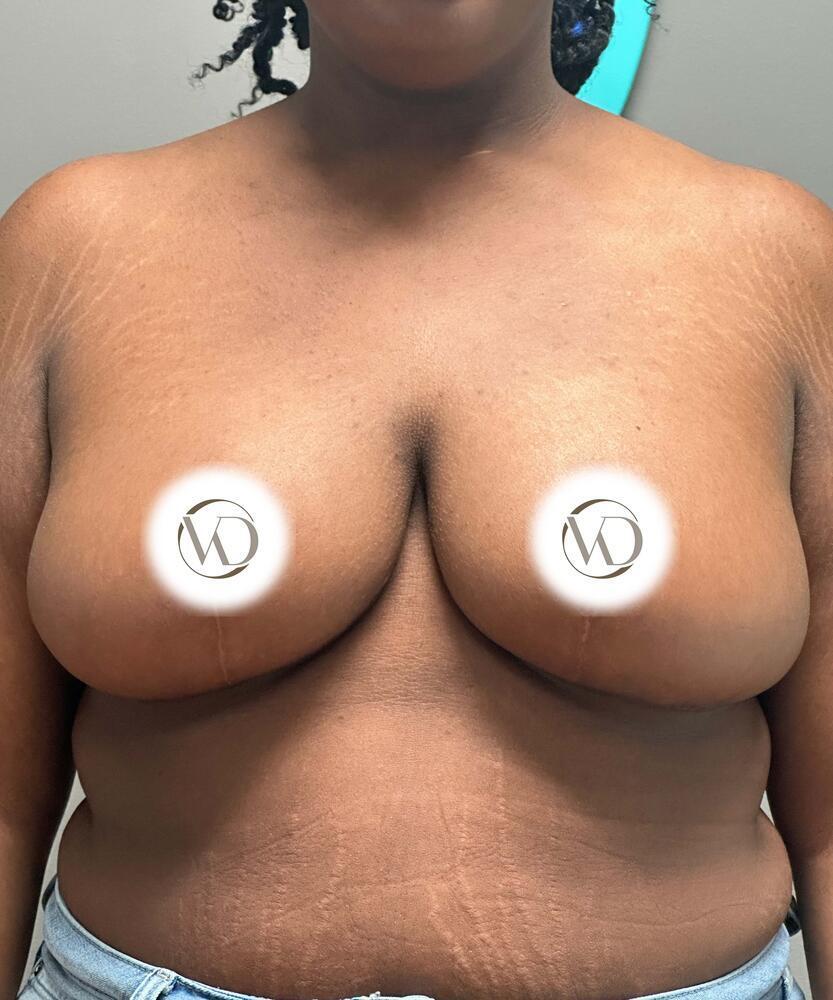 Sculptra Before & After Image