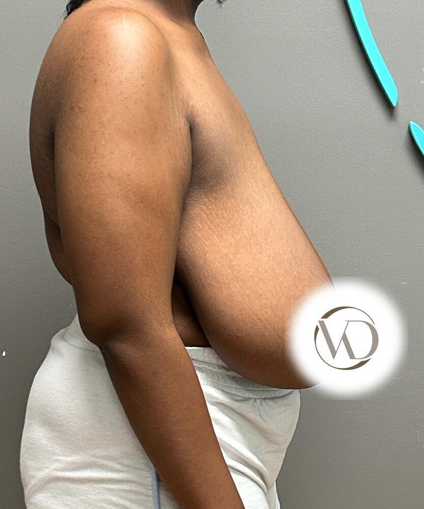 Breast Reduction Before & After Image