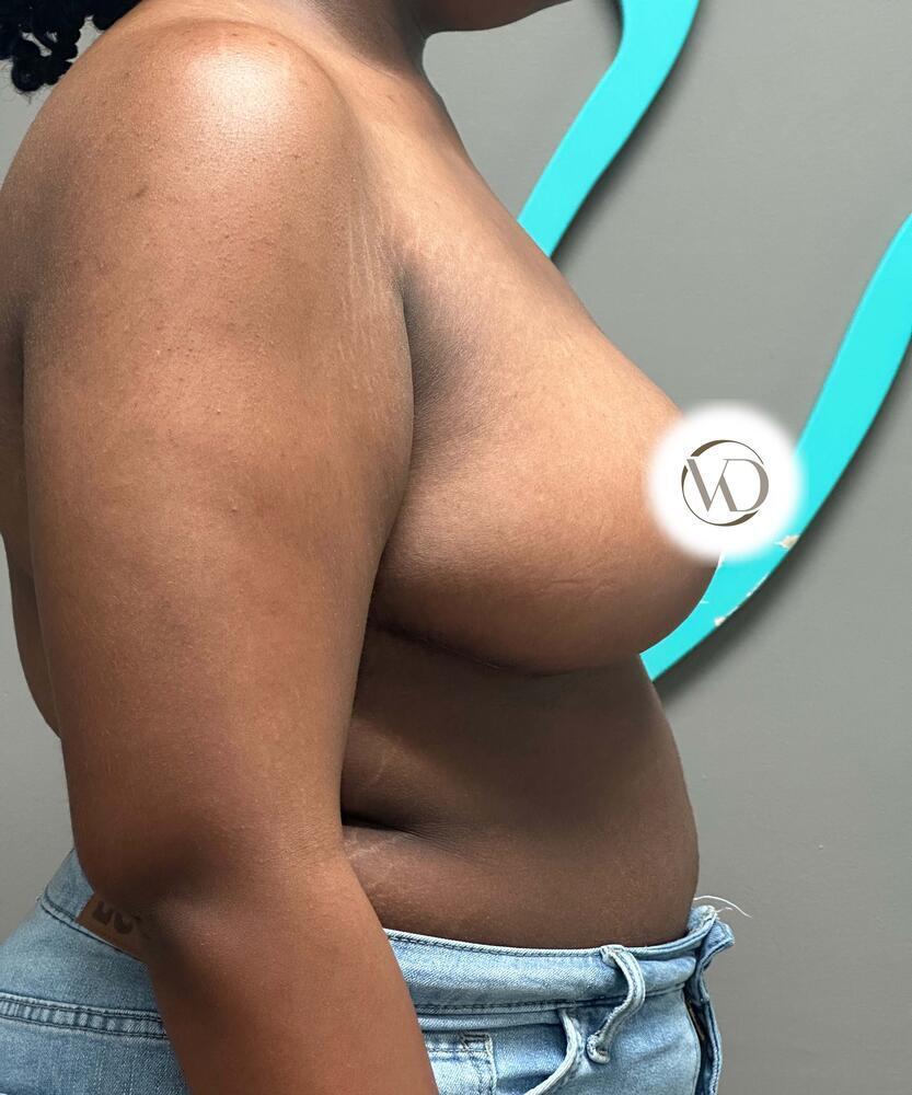 Breast Reduction Before & After Image