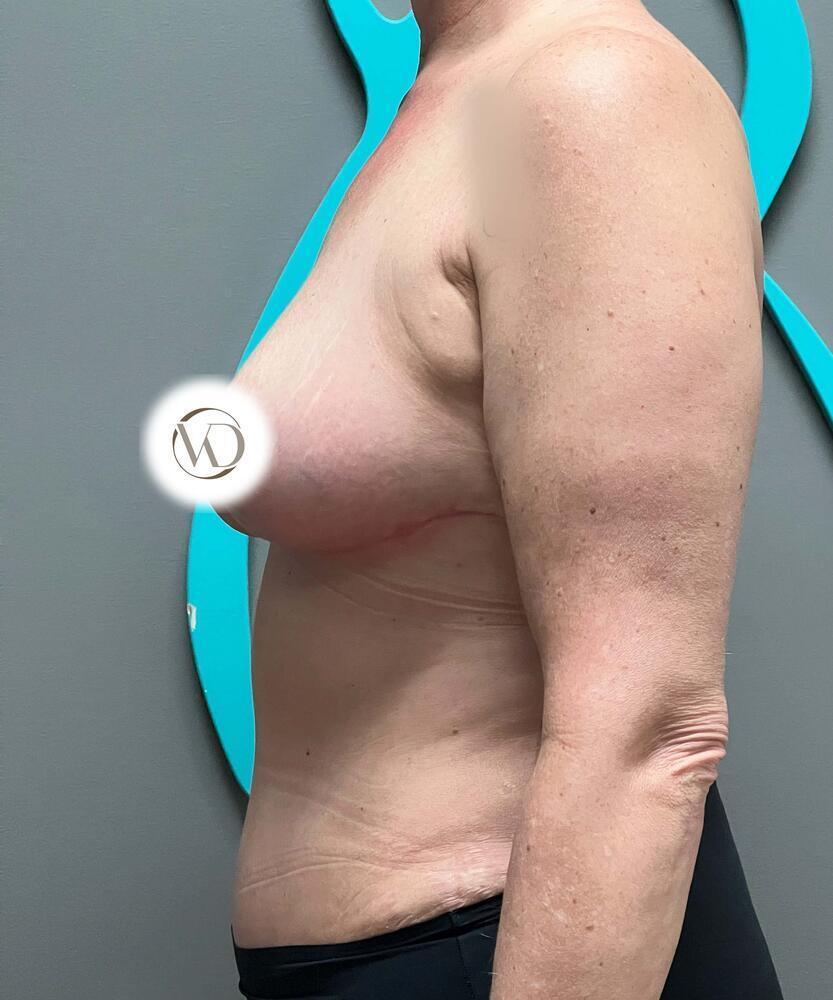 Breast Reduction Before & After Image