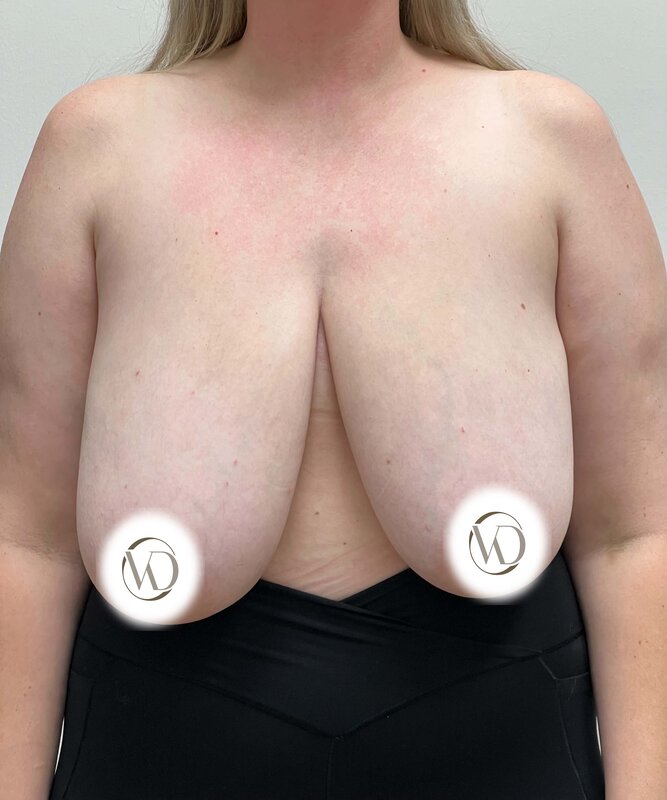 Breast Reduction Before & After Image