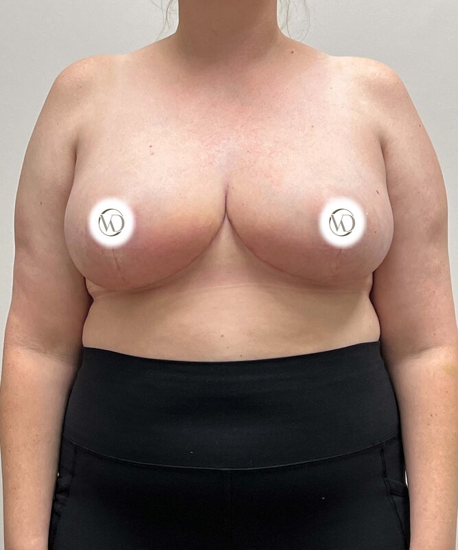 Breast Reduction Before & After Image