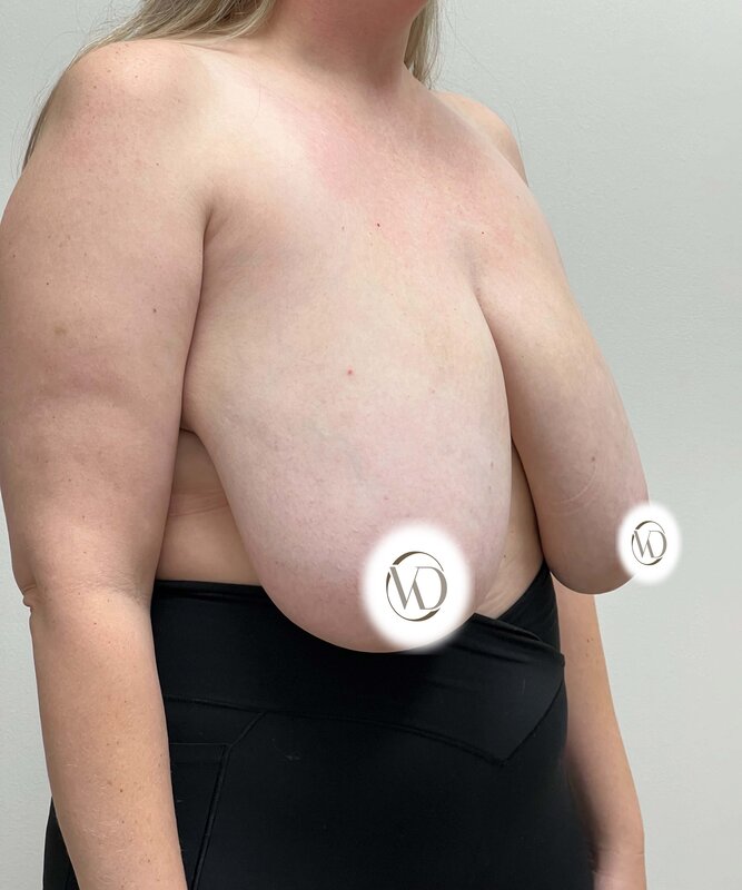 Breast Reduction Before & After Image