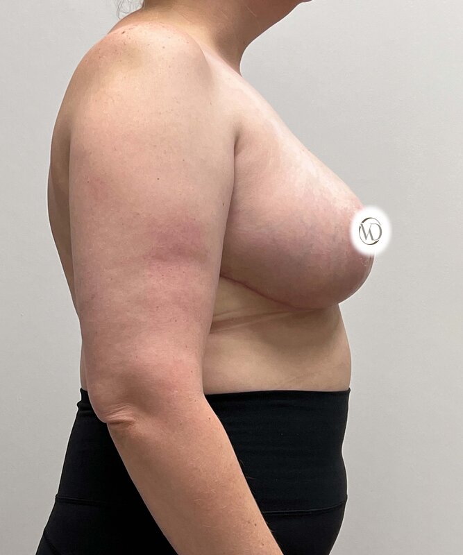 Breast Reduction Before & After Image