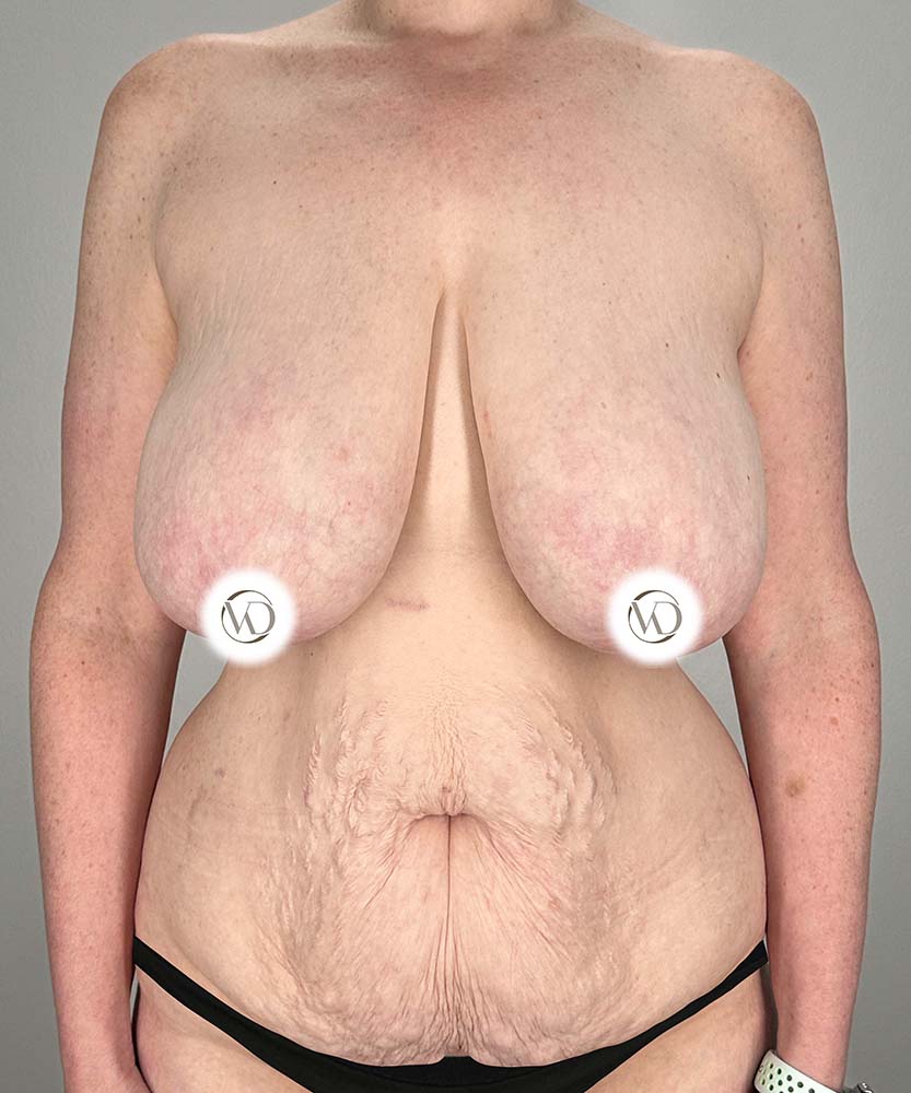 Breast Reduction Before & After Image