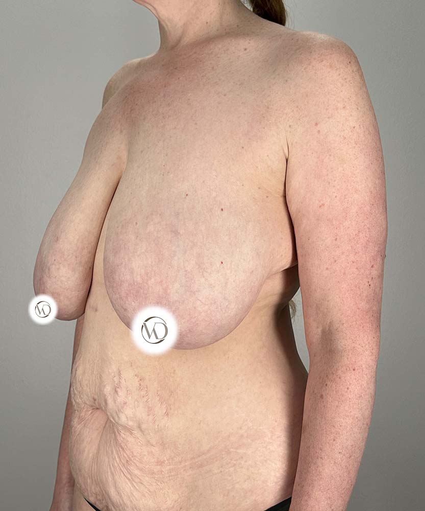 Breast Reduction Before & After Image