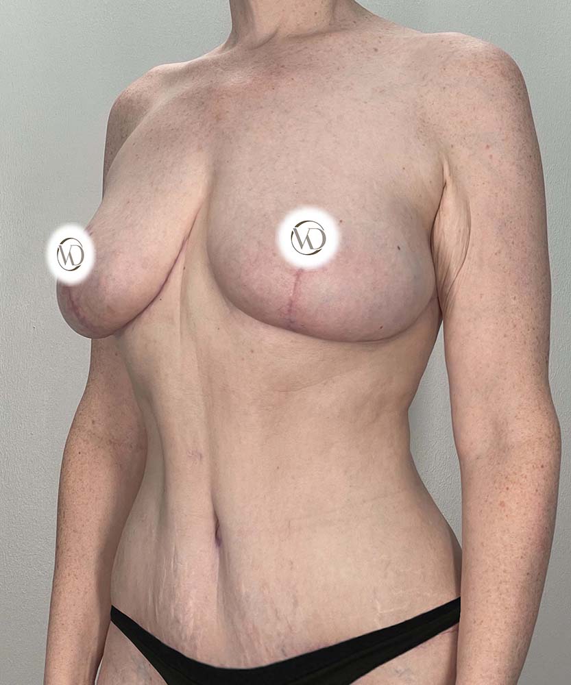 Breast Reduction Before & After Image