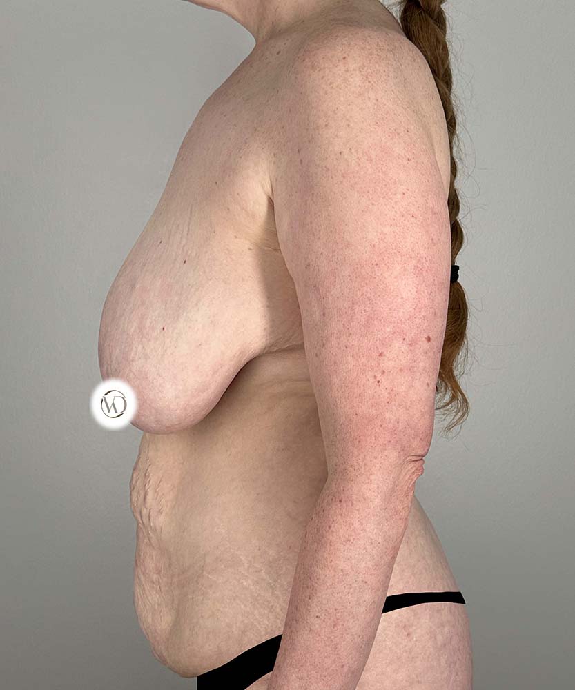 Breast Reduction Before & After Image