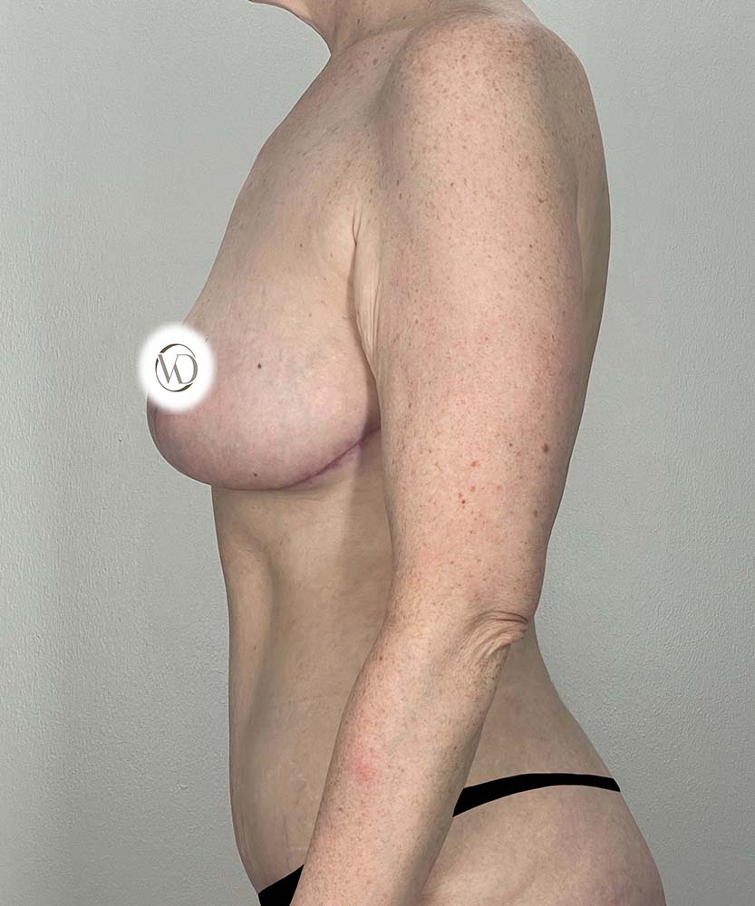 Breast Reduction Before & After Image