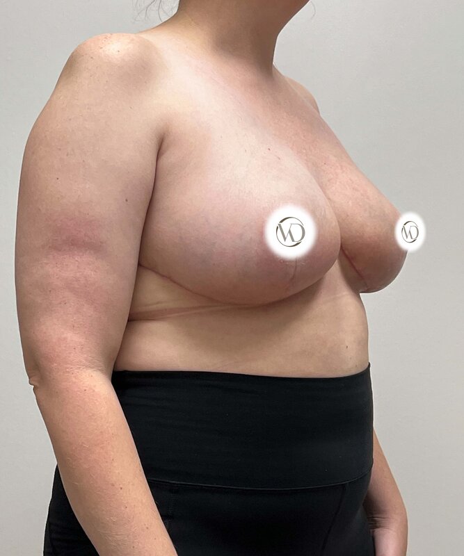 Breast Reduction Before & After Image