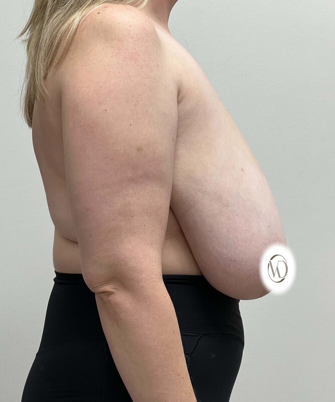 Breast Reduction Before & After Image