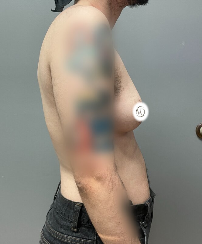FTM Top Surgery Before & After Image