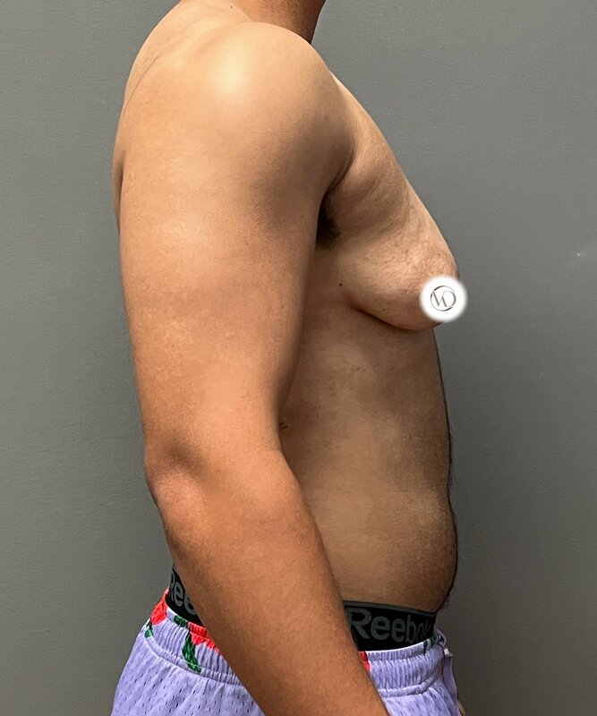 FTM Top Surgery Before & After Image