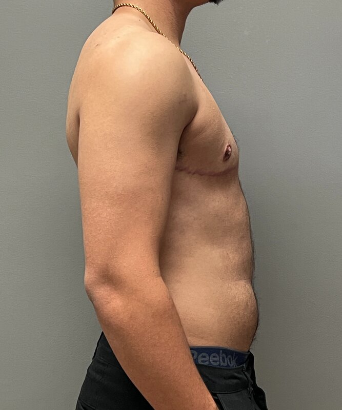 FTM Top Surgery Before & After Image