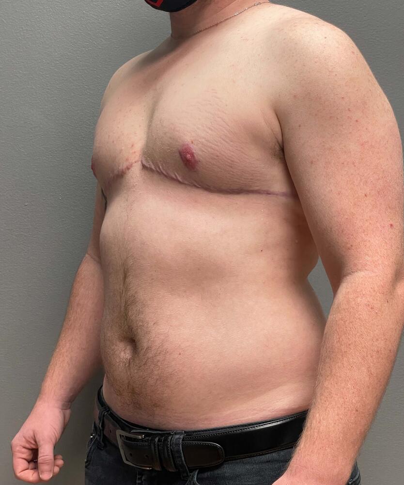 FTM Top Surgery Before & After Image