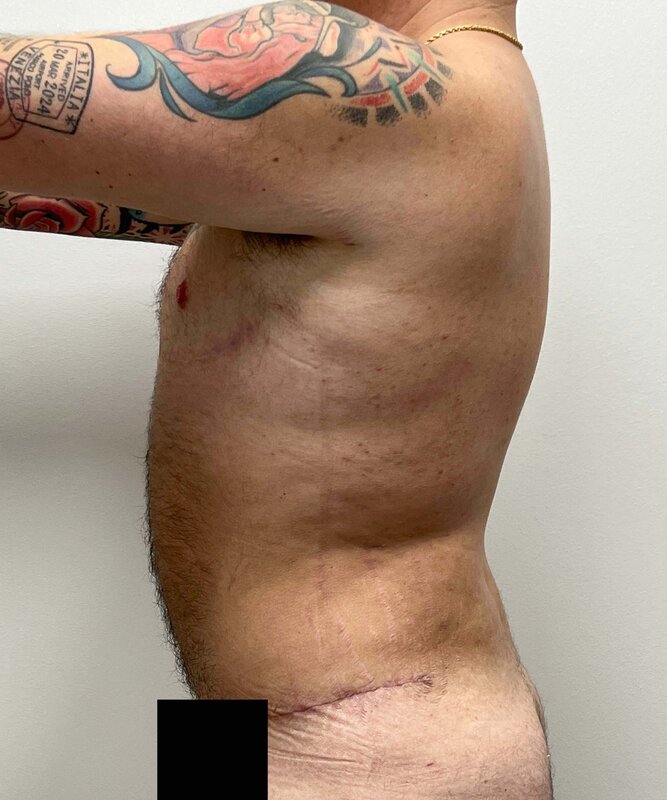 FTM Top Surgery Before & After Image
