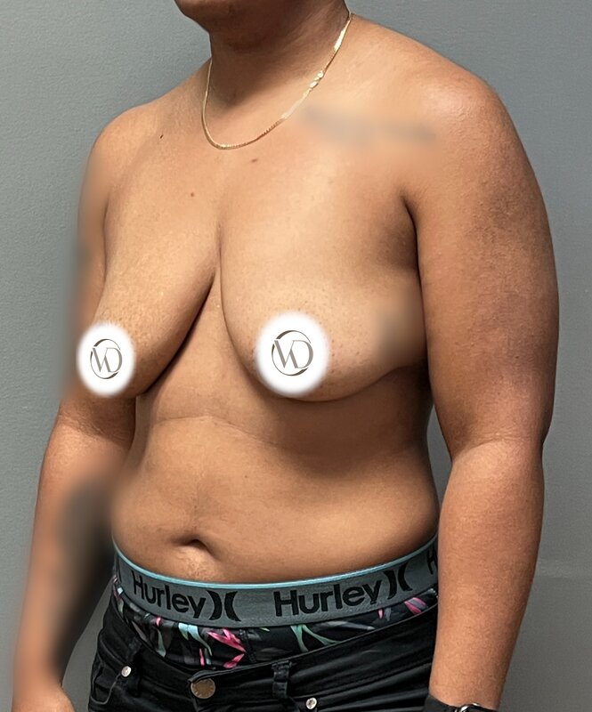 FTM Top Surgery Before & After Image