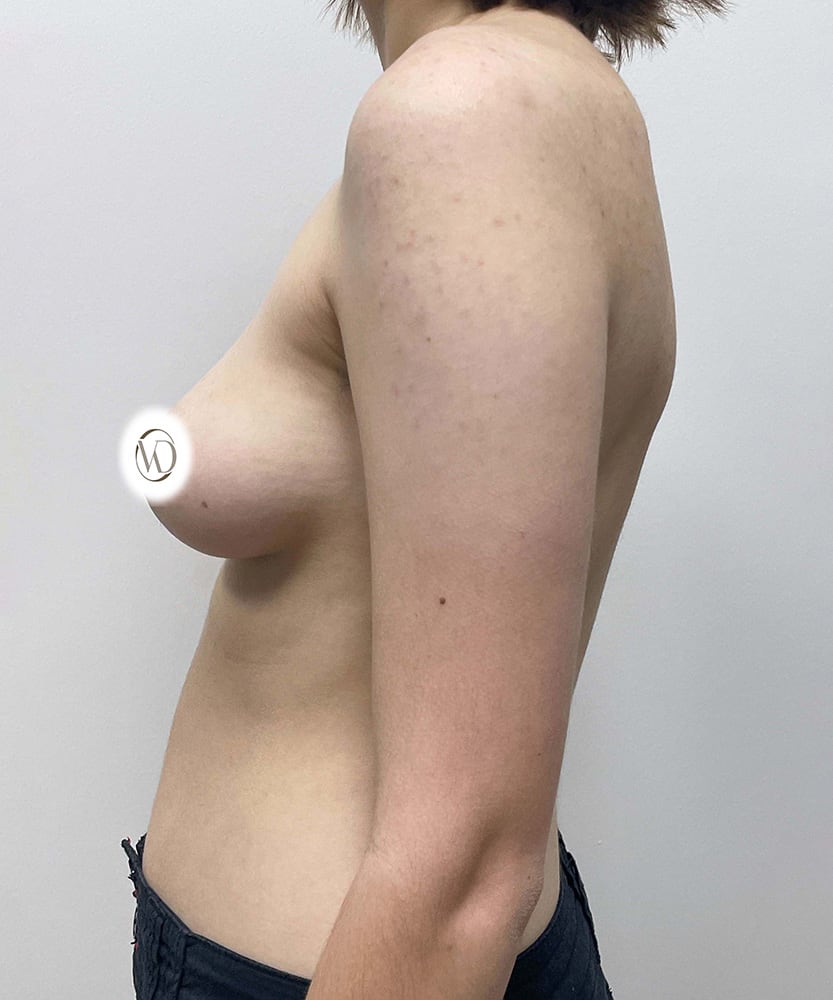 FTM Top Surgery Before & After Image