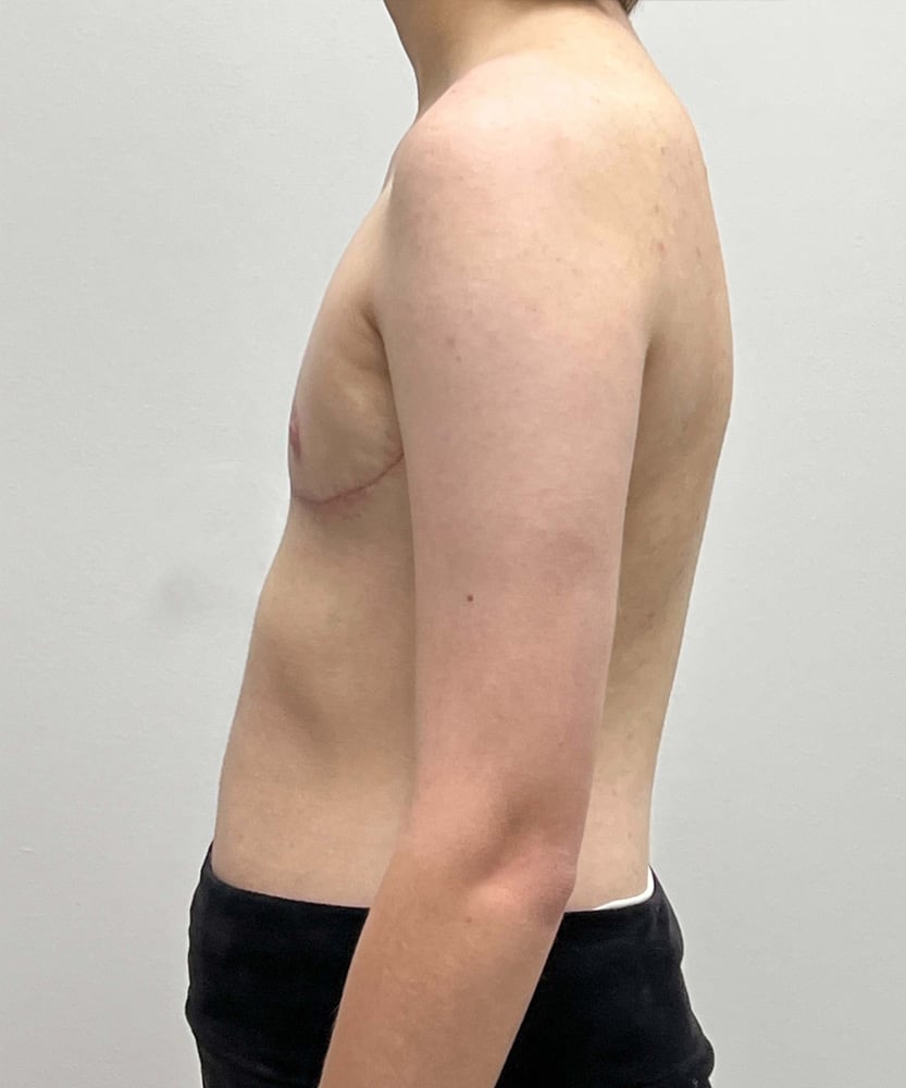 FTM Top Surgery Before & After Image