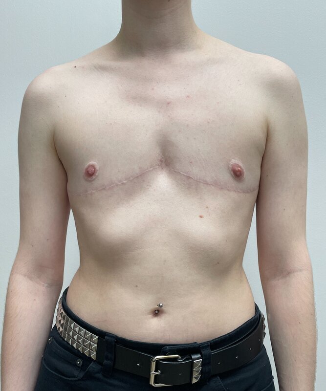 Sculptra Before & After Image