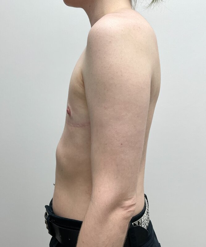 FTM Top Surgery Before & After Image